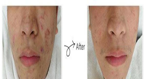 做微晶磨皮<a href=http://www.f3bb6.cn/listinfo-797-0.html target=_blank class=infotextkey>去痘疤</a>副作用