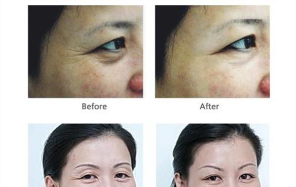 自體脂肪<a href=http://www.f3bb6.cn/listinfo-780-0.html target=_blank class=infotextkey>去魚尾紋</a>適應癥狀是什么？