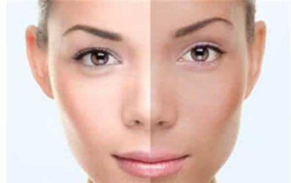 做果酸美白不適應(yīng)人群有哪些