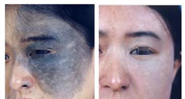 做激光<a href=http://www.f3bb6.cn/listinfo-799-0.html target=_blank class=infotextkey>去太田痣</a>效果好不好