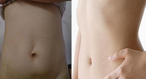 做腹壁整形<a href=http://www.f3bb6.cn/listinfo-791-0.html target=_blank class=infotextkey>去妊娠紋</a>副作用