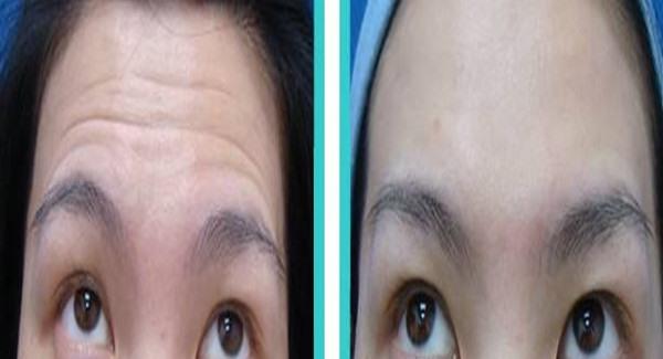 做<a href=http://www.f3bb6.cn/listinfo-765-0.html target=_blank class=infotextkey>去抬頭紋</a>失敗修復手術時間是多久？