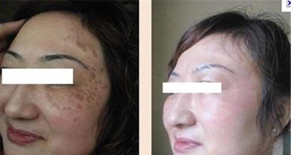 做冷凍法<a href=http://www.f3bb6.cn/listinfo-786-0.html target=_blank class=infotextkey>去黃褐斑</a>價格是多少