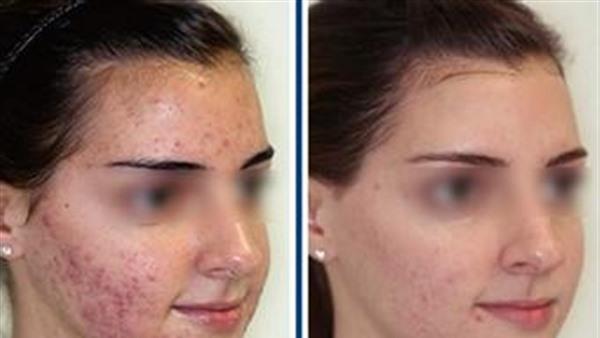 做光子祛痘價格是多少