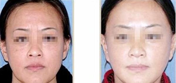 <a href=http://www.f3bb6.cn/listinfo-613-0.html target=_blank class=infotextkey>射頻</a><a href=http://www.f3bb6.cn/listinfo-768-0.html target=_blank class=infotextkey>微針</a><a href=http://www.f3bb6.cn/listinfo-771-0.html target=_blank class=infotextkey>去眉間紋</a>有副作用嗎?