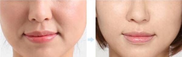 做<a href=http://www.f3bb6.cn/listinfo-734-0.html target=_blank class=infotextkey>愛貝芙</a><a href=http://www.f3bb6.cn/listinfo-792-0.html target=_blank class=infotextkey>去法令紋</a>多少錢