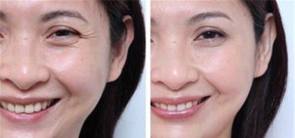 <a href=http://www.f3bb6.cn/listinfo-731-0.html target=_blank class=infotextkey>玻尿酸</a><a href=http://www.f3bb6.cn/listinfo-780-0.html target=_blank class=infotextkey>去魚尾紋</a>效果怎么樣？