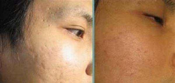 激光去痘印價格多少