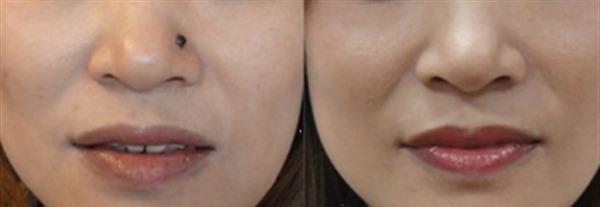 怎么<a href=http://www.f3bb6.cn/listinfo-767-0.html target=_blank class=infotextkey>祛痣</a>安全 <a href=http://www.f3bb6.cn/listinfo-767-0.html target=_blank class=infotextkey>祛痣</a>的安全方法