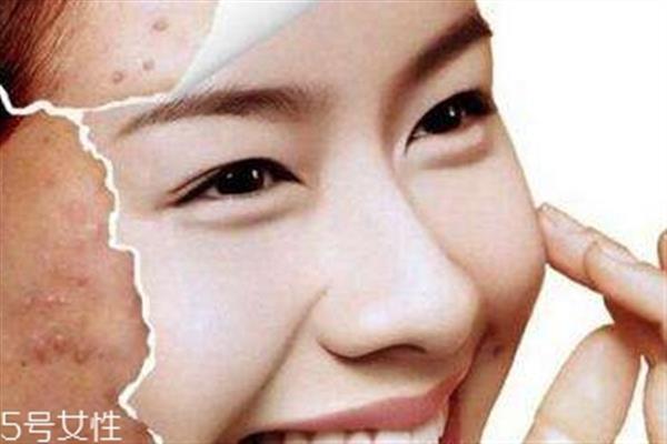 祛痘手術有哪些 4種祛痘手術哪種最好