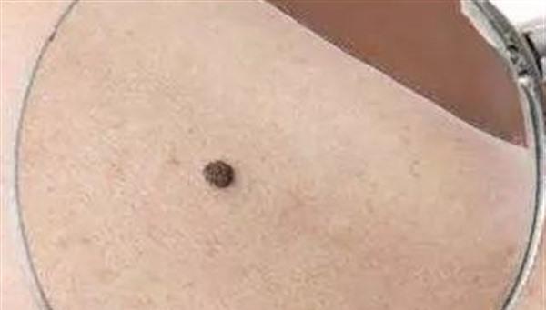 冷凍去痣做完要多久時間？