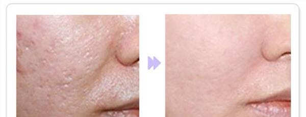 光子去痘印不適用人群有哪些？