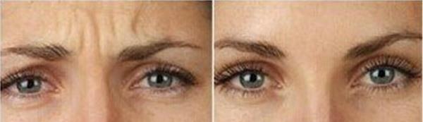 <a href=http://www.f3bb6.cn/listinfo-613-0.html target=_blank class=infotextkey>射頻</a><a href=http://www.f3bb6.cn/listinfo-768-0.html target=_blank class=infotextkey>微針</a><a href=http://www.f3bb6.cn/listinfo-771-0.html target=_blank class=infotextkey>去眉間紋</a>手術的方法是什么?