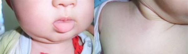 做<a href=http://www.f3bb6.cn/listinfo-777-0.html target=_blank class=infotextkey>治療血管瘤</a>護理方法