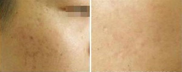 做微晶磨削<a href=http://www.f3bb6.cn/listinfo-774-0.html target=_blank class=infotextkey>去雀斑</a>價(jià)格大概需要多少