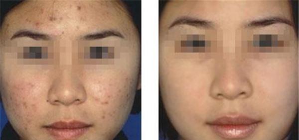 做<a href=http://www.f3bb6.cn/listinfo-730-0.html target=_blank class=infotextkey>黑臉娃娃</a>去痘印不適應(yīng)人群有哪些