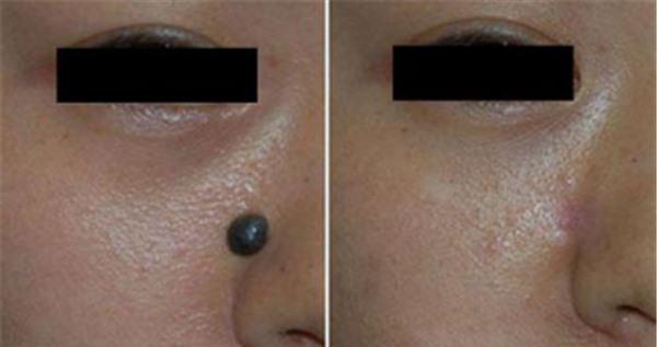 做<a href=http://www.f3bb6.cn/listinfo-788-0.html target=_blank class=infotextkey>去黑痣</a>不適應人群有哪些