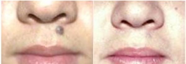 點痣麻醉方式是什么？