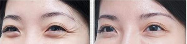 做<a href=http://www.f3bb6.cn/listinfo-734-0.html target=_blank class=infotextkey>愛貝芙</a><a href=http://www.f3bb6.cn/listinfo-782-0.html target=_blank class=infotextkey>去眼角細紋</a>不適應人群有哪些