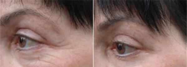 做<a href=http://www.f3bb6.cn/listinfo-734-0.html target=_blank class=infotextkey>愛貝芙</a><a href=http://www.f3bb6.cn/listinfo-780-0.html target=_blank class=infotextkey>去魚尾紋</a>不適應人群有哪些