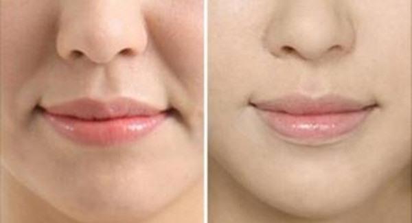 做光子<a href=http://www.f3bb6.cn/listinfo-792-0.html target=_blank class=infotextkey>去法令紋</a>手術時間是多久？