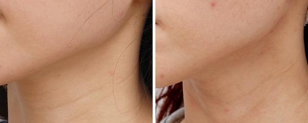 <a href=http://www.f3bb6.cn/listinfo-785-0.html target=_blank class=infotextkey>去頸紋</a>失敗修復適應癥狀是什么？