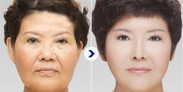 做額顳部<a href=http://www.f3bb6.cn/listinfo-614-0.html target=_blank class=infotextkey>除皺</a><a href=http://www.f3bb6.cn/listinfo-765-0.html target=_blank class=infotextkey>去抬頭紋</a>風險有哪些