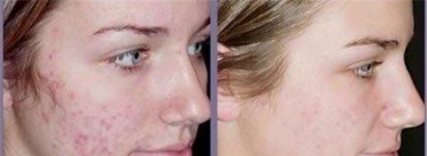做E光祛痘不適應人群有哪些