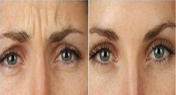 做<a href=http://www.f3bb6.cn/listinfo-731-0.html target=_blank class=infotextkey>玻尿酸</a><a href=http://www.f3bb6.cn/listinfo-771-0.html target=_blank class=infotextkey>去眉間紋</a>副作用是什么