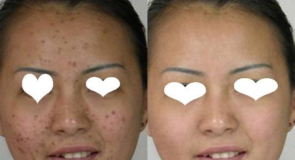 做激光去痘印副作用是什么