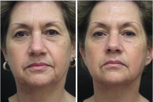 E光<a href=http://www.f3bb6.cn/listinfo-792-0.html target=_blank class=infotextkey>去法令紋</a>手術缺點有哪些？