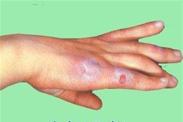 凍瘡疤痕修復手術缺點有哪些？