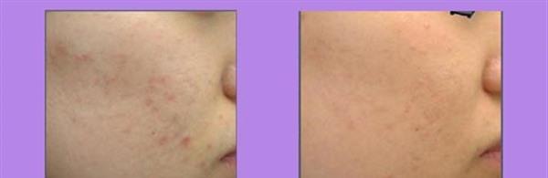 做切開填充治療痘疤效果好不好