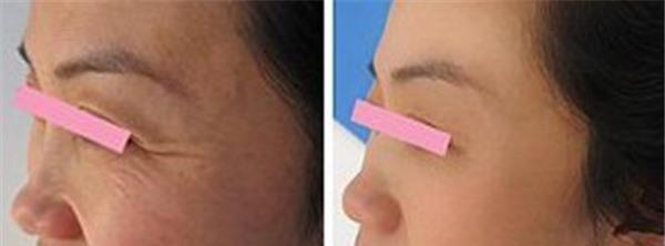 做小切口<a href=http://www.f3bb6.cn/listinfo-614-0.html target=_blank class=infotextkey>除皺</a><a href=http://www.f3bb6.cn/listinfo-780-0.html target=_blank class=infotextkey>去魚尾紋</a>價格多少錢