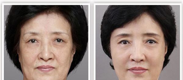 做青春解碼儀美膚副作用是什么