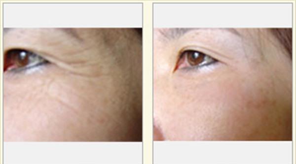 做<a href=http://www.f3bb6.cn/listinfo-782-0.html target=_blank class=infotextkey>去眼角細紋</a>失敗修復價格