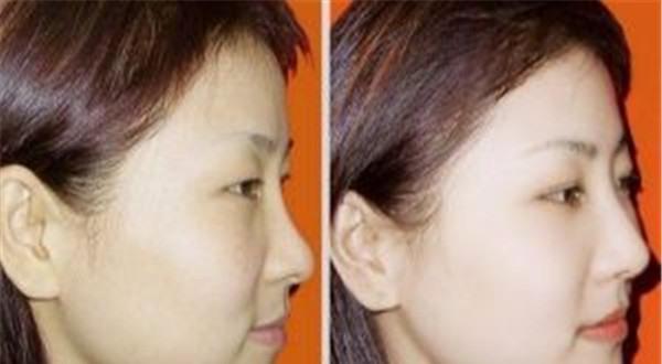 做無針水光價格