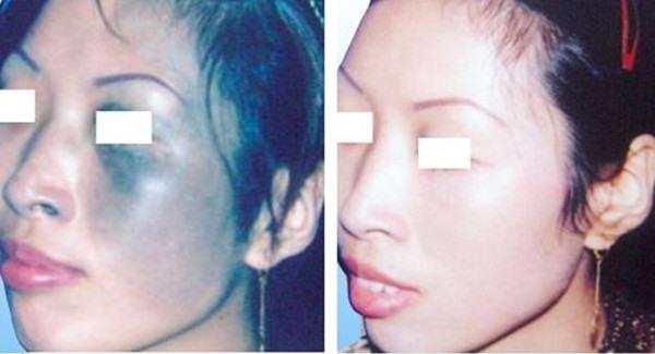 做<a href=http://www.f3bb6.cn/listinfo-799-0.html target=_blank class=infotextkey>去太田痣</a>失敗修復價格是多少