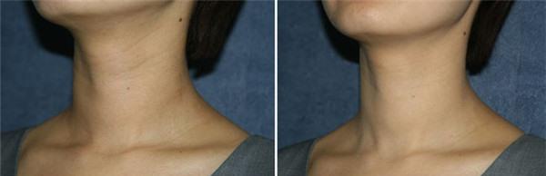 做激光除頸紋價格是多少