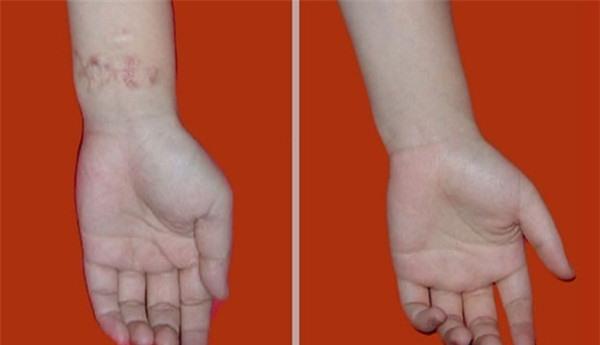 做燒傷疤痕修復(fù)價(jià)格