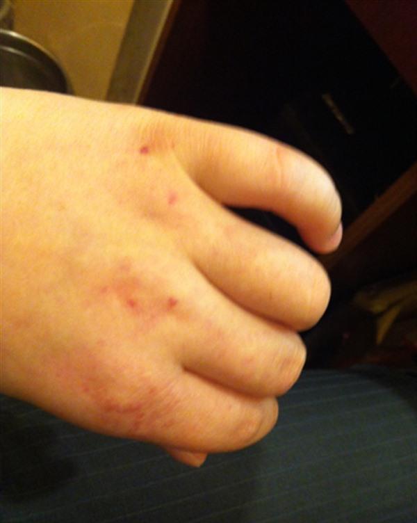 做凍瘡疤痕修復價格是多少