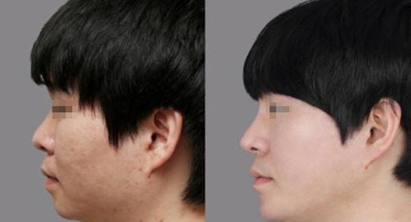 做激光<a href=http://www.f3bb6.cn/listinfo-797-0.html target=_blank class=infotextkey>去痘疤</a>手術時間是多久?