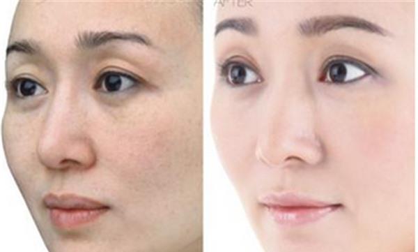 果酸<a href=http://www.f3bb6.cn/listinfo-770-0.html target=_blank class=infotextkey>嫩膚</a>適用于哪些人？