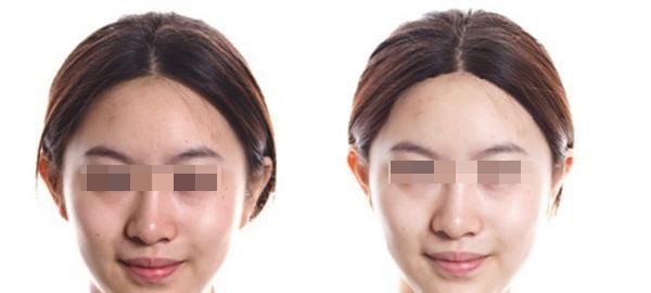 RV極速美塑美膚適合什么人？