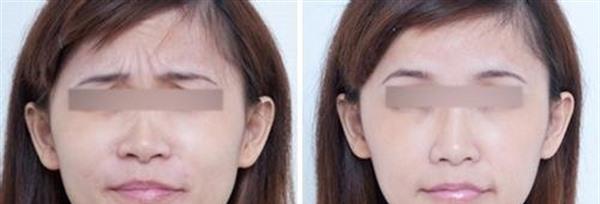 脈沖光<a href=http://www.f3bb6.cn/listinfo-771-0.html target=_blank class=infotextkey>去眉間紋</a>效果怎么樣？