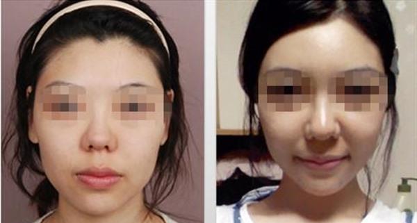 自體脂肪<a href=http://www.f3bb6.cn/listinfo-782-0.html target=_blank class=infotextkey>去眼角細紋</a>手術術后護理？