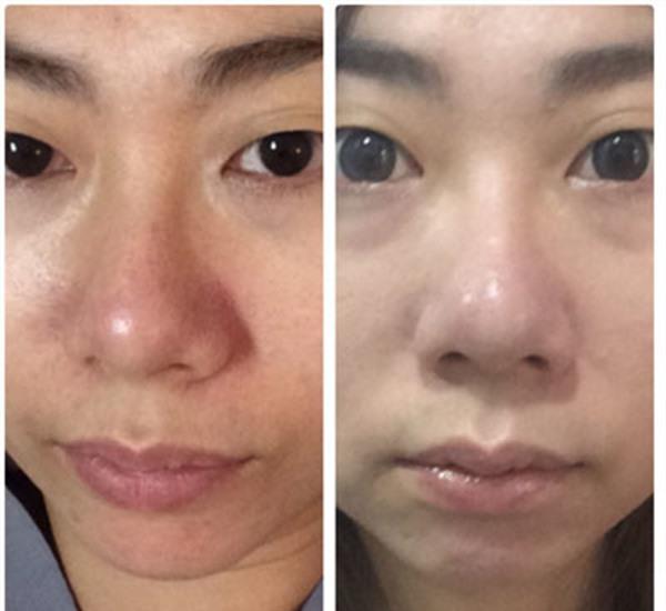 果酸煥膚<a href=http://www.f3bb6.cn/listinfo-781-0.html target=_blank class=infotextkey>祛痘印</a>手術術后護理？