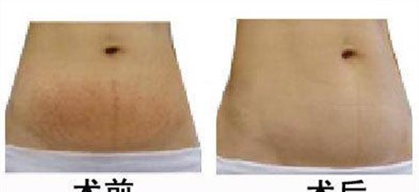 光子<a href=http://www.f3bb6.cn/listinfo-791-0.html target=_blank class=infotextkey>去妊娠紋</a>手術術后護理？