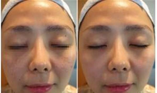 微晶磨皮<a href=http://www.f3bb6.cn/listinfo-780-0.html target=_blank class=infotextkey>去魚尾紋</a>手術(shù)術(shù)后護(hù)理？