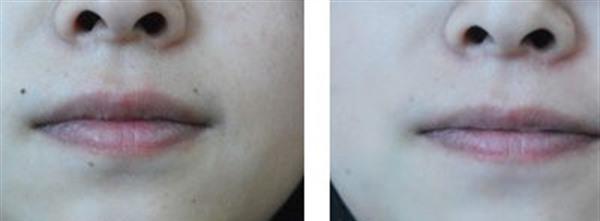 E光點(diǎn)痣手術(shù)安全嗎？